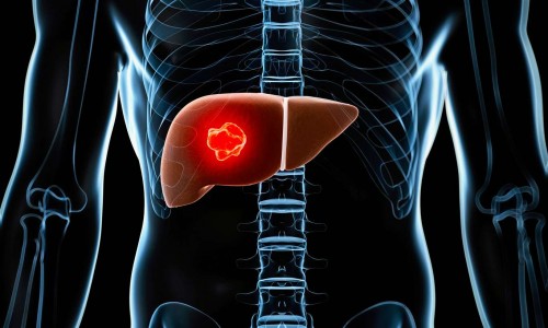 Nuevo Tratamiento Sueco Elimina Los Tumores Con Menos Efectos Secundarios Nuevo Tratamiento Sueco Elimina Los Tumores Con Menos Efectos Secundarios